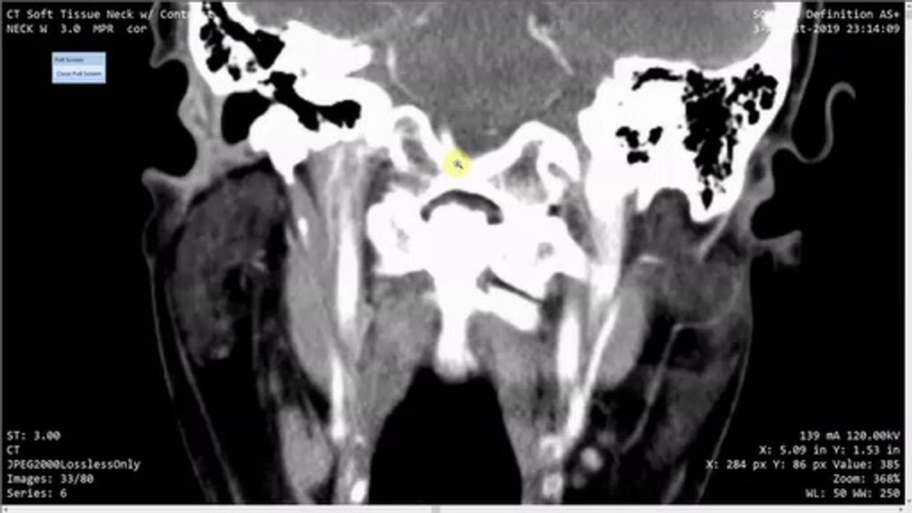 Found  A Wulf / Botfly / Insect In My X-Ray / CT / MRI - Misdiagnosis!