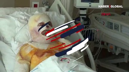 Çay demlemek istediği sobayı benzinle tutuşturunca ölümden döndü