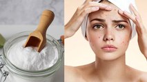 Baking Soda On Pimples: मुंहासे वाली त्वचा पर बेकिंग सोडा के नुकसान | Baking Soda ke Nuksan |Boldsky