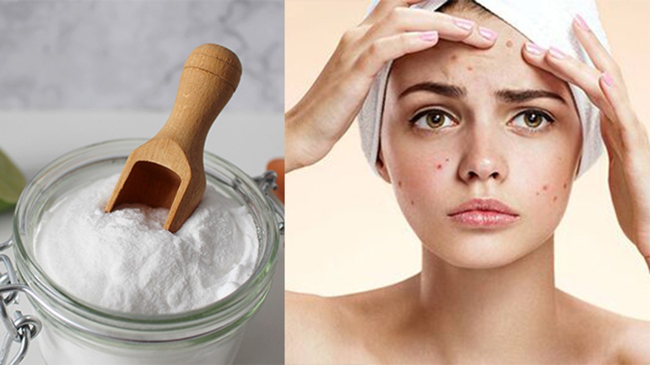 Baking Soda On Pimples: मुंहासे वाली त्वचा पर ब...