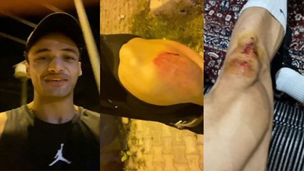 Asim Riaz पर देर रात बाइक सवार ने किया हमला,बुरी तरह हुए घायल, Video आया सामने । Boldsky