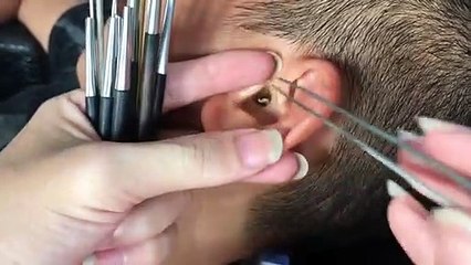 You will be stunned by what came out of  ears| कान में से जो निकला उसे देखकर आप दंग रह जाएंगे