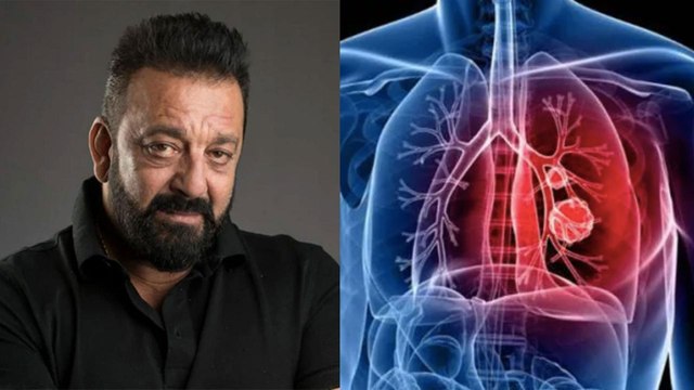 Know what is stage 3 lung cancer?