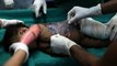 Brazilian doctors use tilapia fish skin to treat burn victims