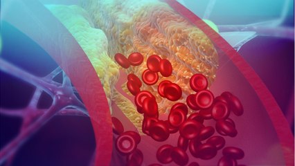 COVID-19 Causes, Worsens Heart Issues