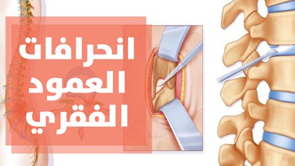 تعرف على أبرز أسباب انحرافات العمود الفقري ومشاكل القوام