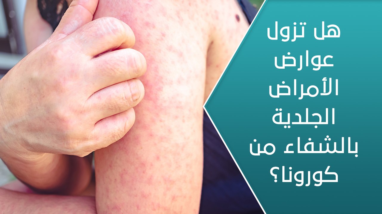 هل تزول عوارض الأمراض الجلدية بالشفاء من كورونا؟ - العيادة