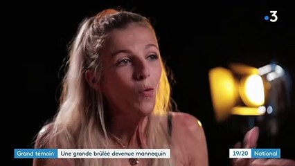 Grand témoin : une grande brûlée devenue mannequin