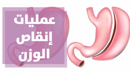 العمليات الجراحية لإنقاص الوزن..ما بين الضرورة والخطورة