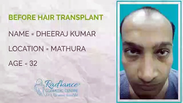Hair Transplant Testimonials Before and After Hair Transpation Surgery India Delhi Testimonials