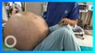 Tumor raksasa seberat 50 kg diangkat dari ovarium wanita India - TomoNews