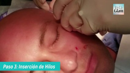 Hilos Tensores con el Doctor Campos