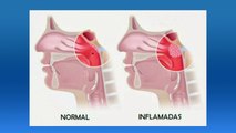 bd-causas-y-tratamientos-para-las-adenoides-inflamadas-010920