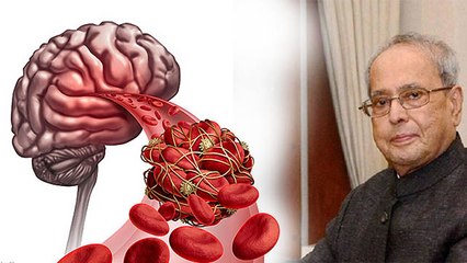 Pranab Mukherjee का जिस बीमारी के चलते हुआ निधन, जानें कितनी खतरनाक है वो | Boldsky