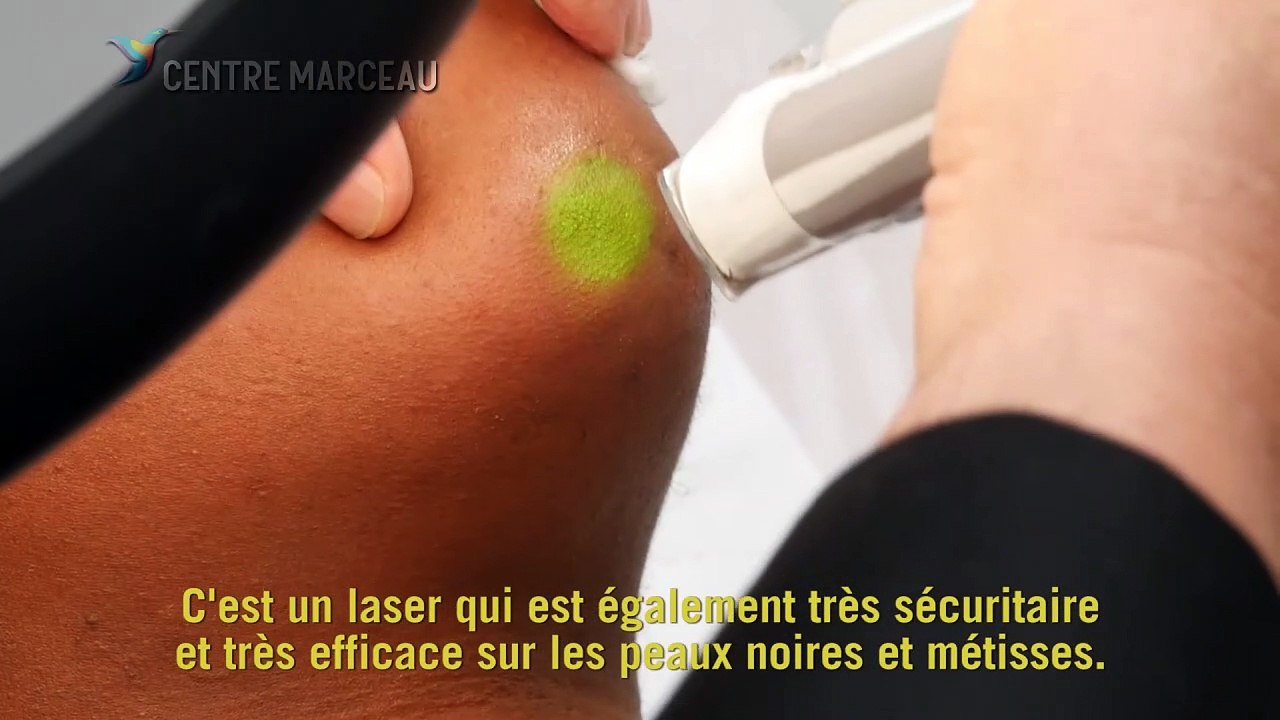 Epilation laser définitive - Quels types de laser ?