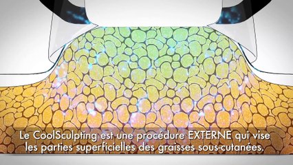 Affiner la SILHOUETTE après la GROSSESSE - La cryolipolyse avec le CoolSculpting à Paris