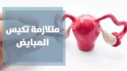متلازمة تكيس المبايض