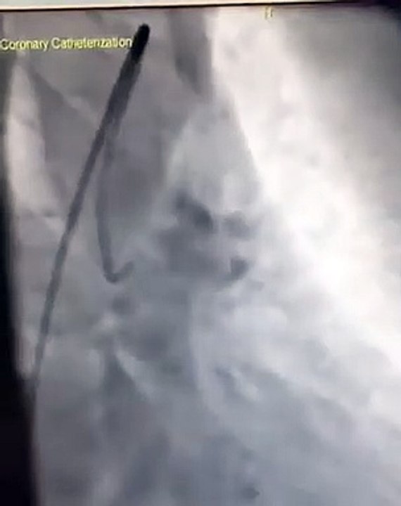 RUTİN KONTROLDE ORTAYA ÇIKAN KALBİN ANA DAMARINDA DARLIK
