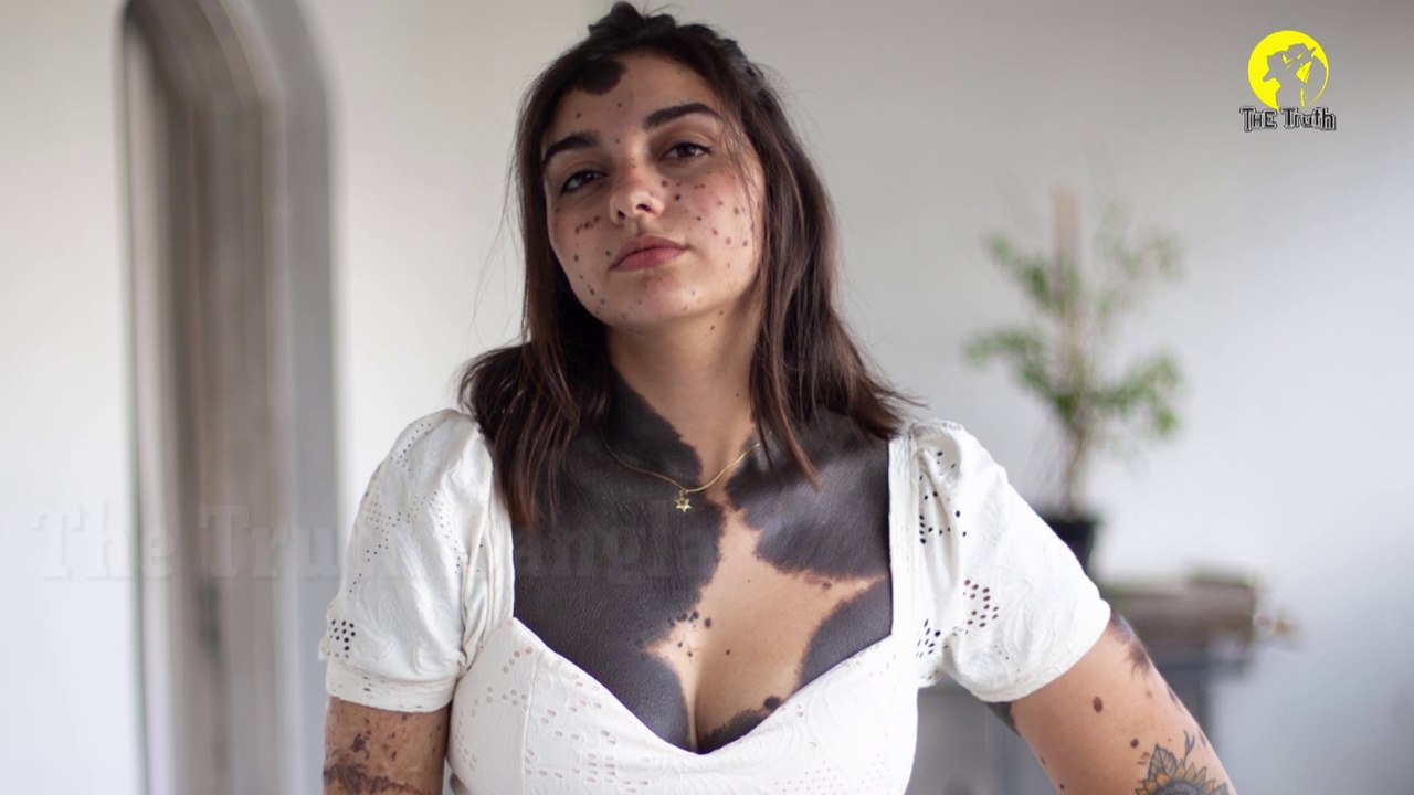 পুরো শরীরের ৮০ ভাগই ঢেকে আছে জন্মদাগে। 80% Covered in birthmarks l The truth Bangla l