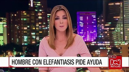 Hombre con elefantiasis busca una solución para su salud