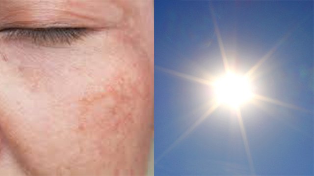 सूरज की कौन सी किरण आपकी स्किन को करती है ज्यादा Damage | UVA OR UVB Rays | Boldsky