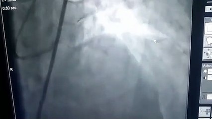 BYPASS ÖNERİLEN HASTAYA STENT TAKILABİLİR Mİ?