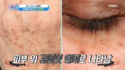 ※충격※ 몸속에 검버섯이…?!