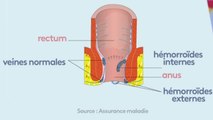 Santé - Tout sur les hémorroïdes