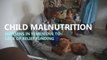 Child malnutrition worsens in Yemen due to lack of relief funding