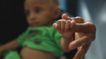 La desnutrición infantil en Yemen se agrava ante la falta de fondos de ayuda