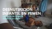 Los programas para combatir la desnutrición infantil en Yemen sufren recortes en sus fondos