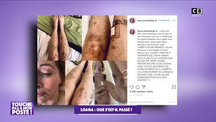 Loana rouée de coups par son ex-conjoint : Elle publie les photos sur son compte Instagram