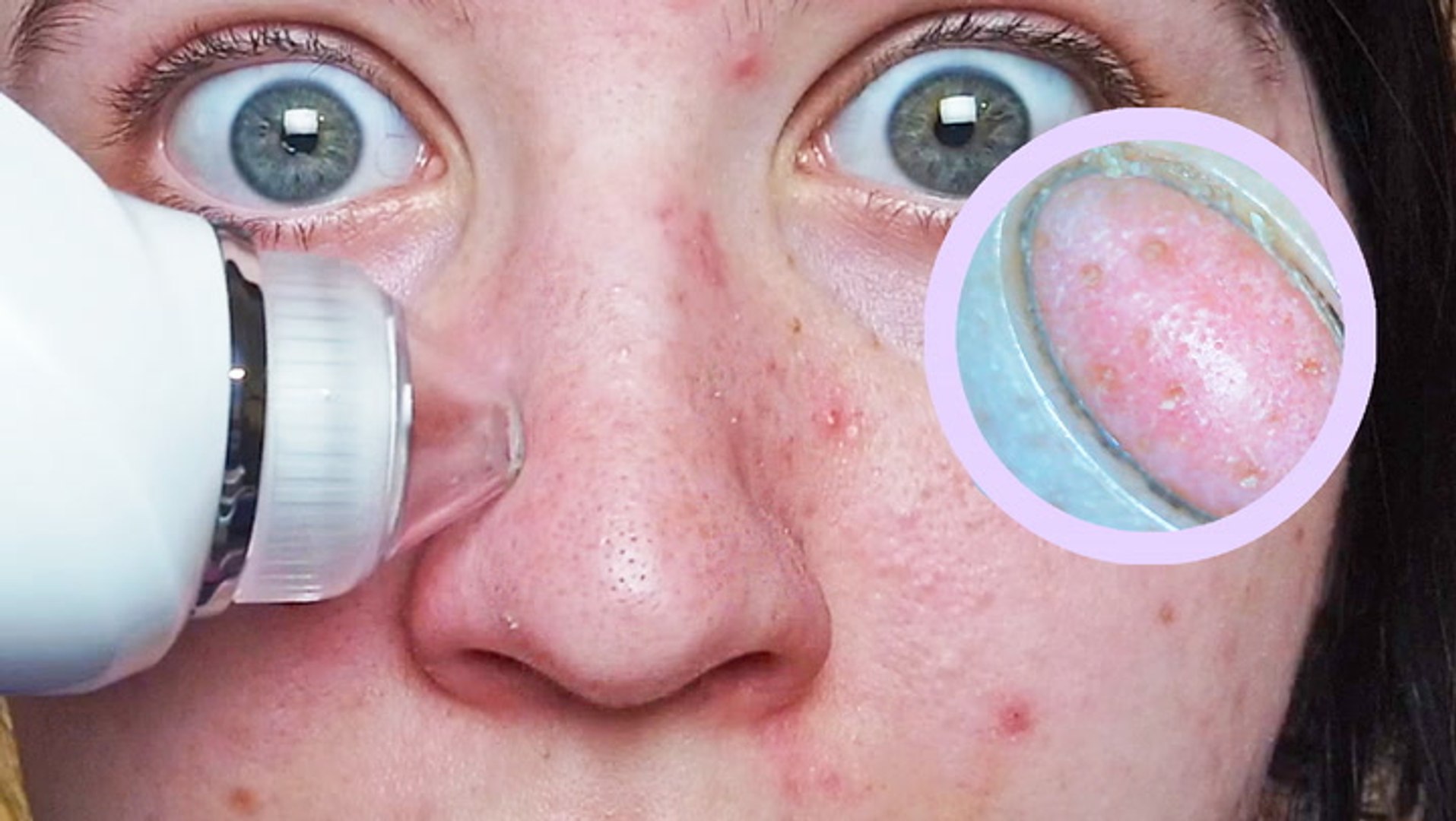 We used a pore vacuum with a built-in microscope to suck out our  blackheads—here's what happened - video Dailymotion