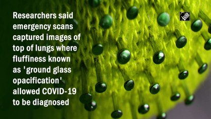 Stroke scans could reveal Covid-19 infection