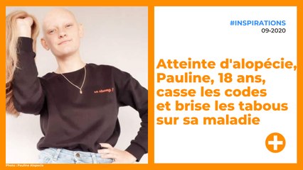 Atteinte d'alopécie, Pauline, 18 ans, casse les codes et brise les tabous sur sa maladie