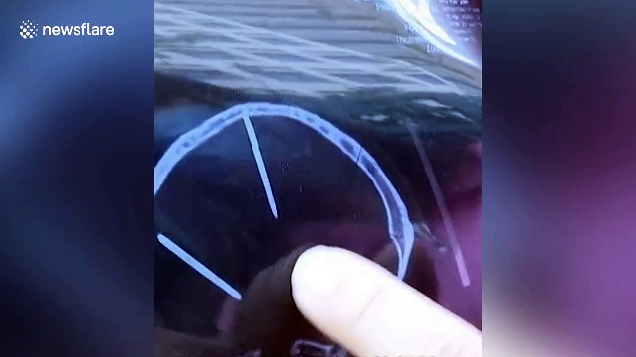 Needles found in woman's head during CT scan after car accident in China