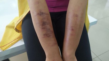 Lazer genç kadının vücudunu yaktı