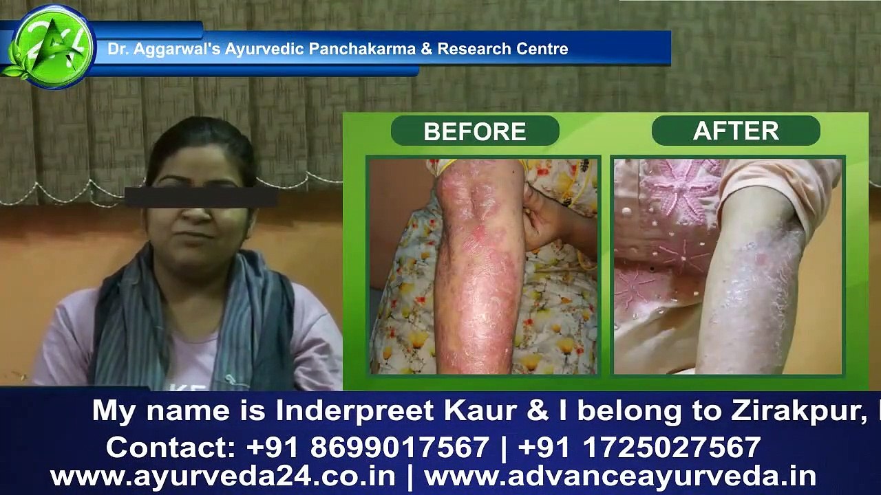 #psoriasis #Draggarwal #Advanceayurveda  - Ayurvedic Treatment for Psoriasis -  Psoriasis Testimony