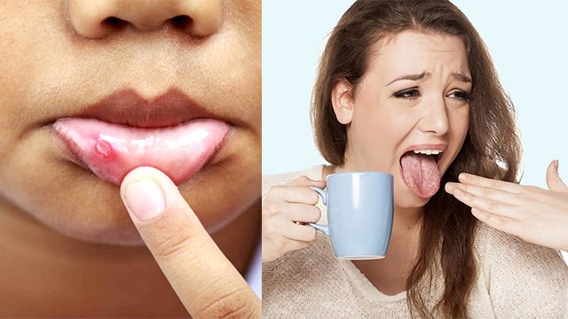 मुंह में छाले क्यों होते है | मुंह में छाले होने की दवा | मुंह में छाले होने का कारण | Boldsky