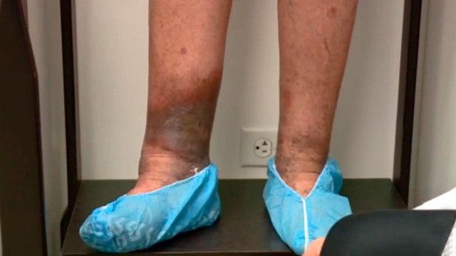 bd-consultorio-abierto-varices-y-dolor-de-piernas-021020