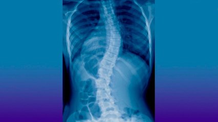 bd-lo-que-debe-saber-de-la-escoliosis-021020
