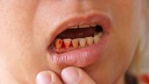 दांतों से खून आना | दांतों से खून क्यों आता है | दांतों से खून आने का इलाज | Boldsky