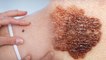 Skin Cancer की ऐसे करें पहचान, जानें क्या है Symptoms and Precautions | Boldsky