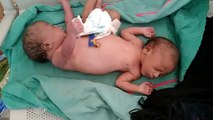 कुदरत का करिश्मा कहें या किस्मत का खेल, दो मूँह चार हाथ दो पैर के बच्चे ने दिया जन्म