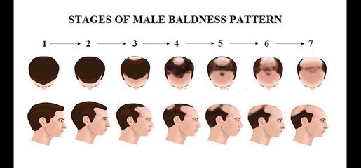 Body Hair Transplant in Chandigarh - Body Hair to Head Hair Transplant | Cosmo Care & Hair Clinic