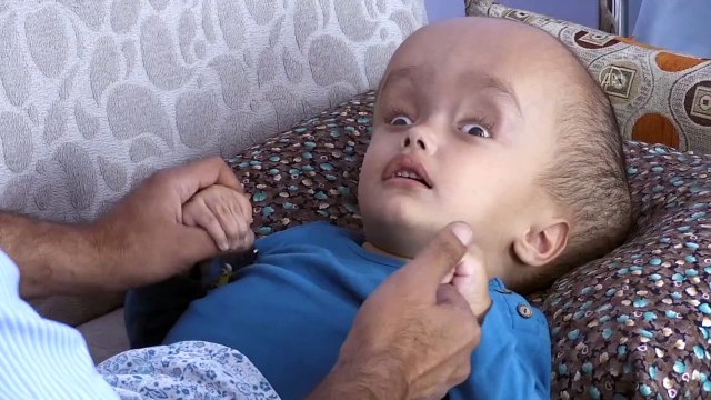 Hidransefali hastası Sercan'ın sağlığı iyiye gidiyor - MANİSA