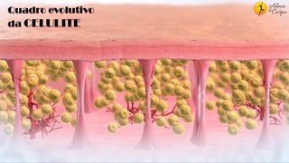 Você sabe de onde vem sua celulite?... Saiba o que é celulite, quais as causas, formas e graus!