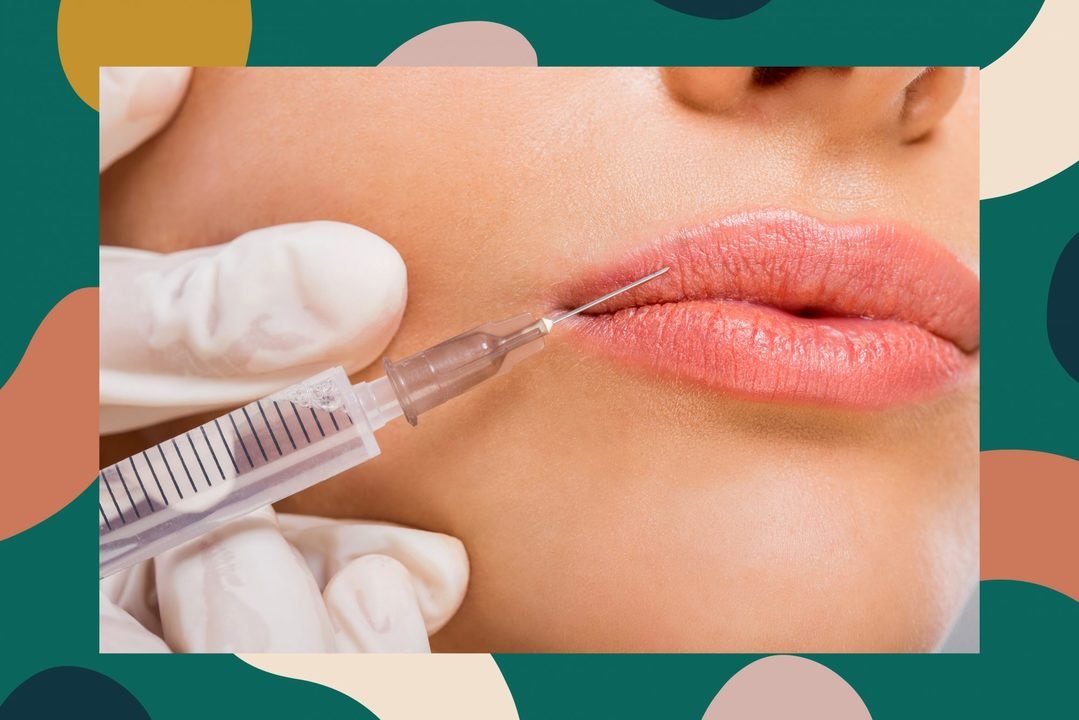 This Is What Getting Lip Injections Actually Feels Like