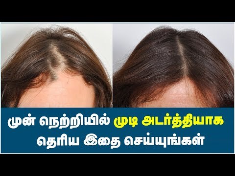 Best Solution for Front Line Hair Fall ! | Front Line Hair Fixing Products