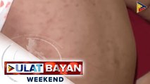 DOH: Tigdas outbreak sa mga nasa edad 5 pababa, posible sa 2021